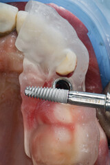 excellent dental moment of the implant and template for precise placement