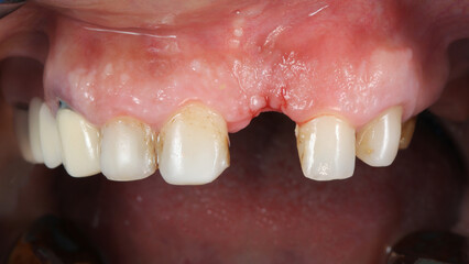 upper jaw without central tooth before implantation © Dental Pro Content