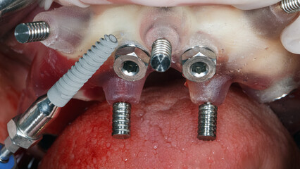 installation of a dental implant through a surgical template of the upper jaw © Dental Pro Content