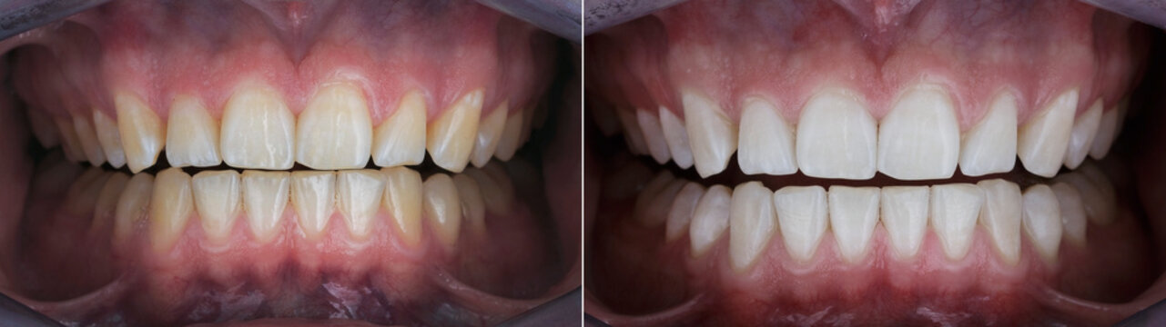 dental photo comparison before and after teeth whitening