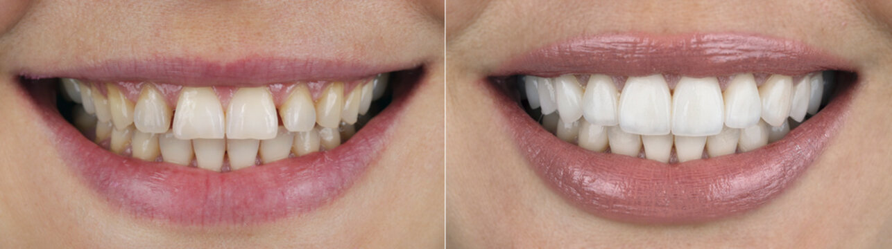 dental photo comparison before and after veneers in a smile