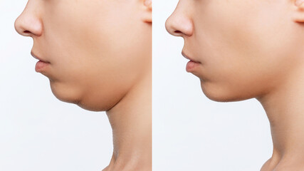 Liposuction of the double chin. Cropped shot of woman's face with chin before and after cosmetic plastic surgery isolated on a white background. The result of lifting. Fat removal, weight loss