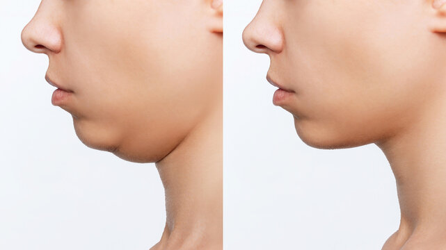can you tighten loose skin under chin - YouTube