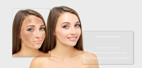 Hyperpigmentation: chloasma, melasma , age spots,Post-inflammatory hyperpigmentation.Hyperpigmentation removal