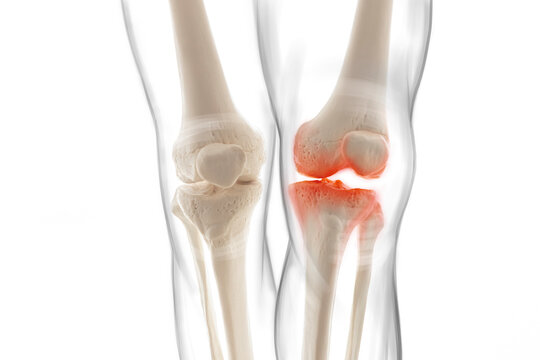 Medically accurate representation of an arthritic knee joint, knee meniscus, human leg