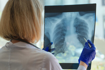 Doctor examines chest x-ray of patient in hospital