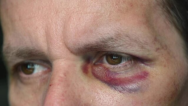 Close-up with selective focus of a man with a bruise and hematoma on his face.