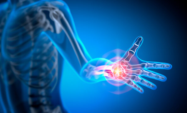 Painful Hand Joint - 3D Illustration