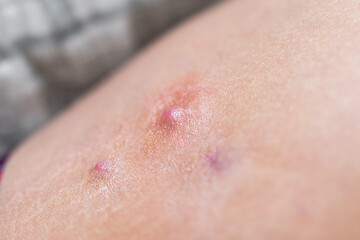 Macro closeup of red swollen boil pimple on leg skin of female woman showing medical condition...
