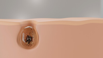 Serum through the skin layer for removing inflammatory acne. 3d rendering. treatment of inflammatory acne and treatment of moderate to severe acne. 