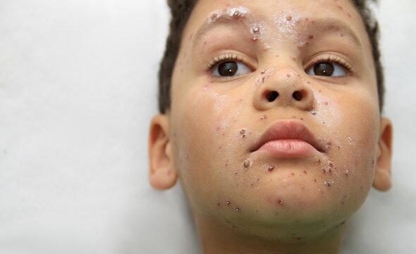 little boy with chickenpox all over his face on white background with people stock photo