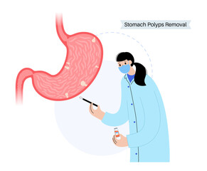Stomach polyp removal