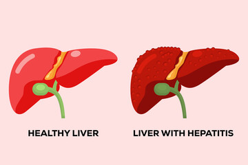 human healthy liver and human liver with hepatitis