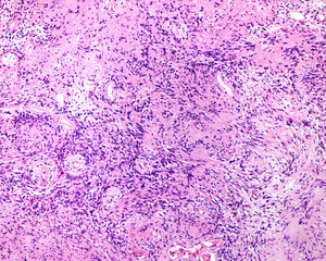 Degenerated or ancient neurilemmoma