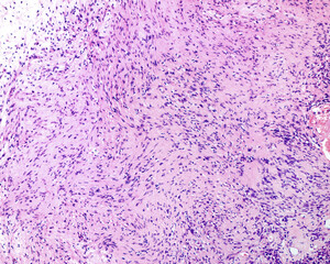 Neurilemmoma or schwannoma
