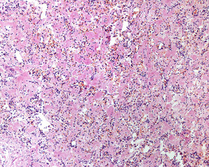 Human spleen. Amyloidosis