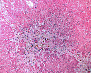 Toxic liver disease. Carbon tetrachloride