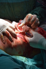Plastic surgeon doing breast implant. Breast augmentation and reduction surgery