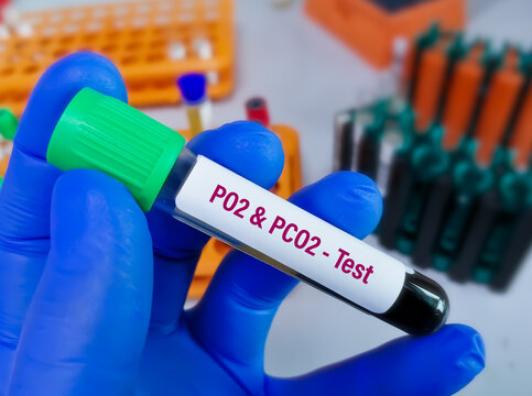 Blood Sample For PCO2 (partial Pressure Of Carbon Dioxide), PO2 (partial Pressure Of Oxygen) Test.