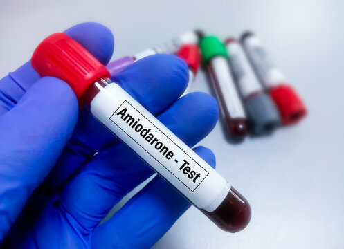 Blood sample for Amiodarone level test, to set therapeutic range of amiodarone a drug to prevent cardiac arrhythmia.