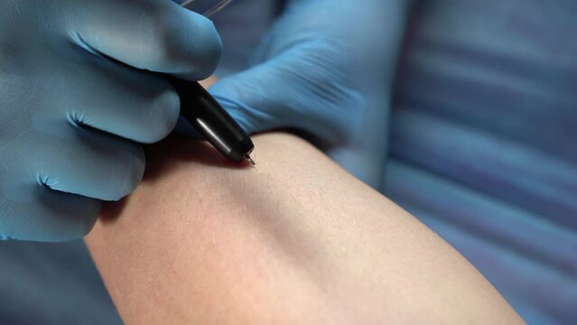 Process electro epilation hair from woman's legs. Close up. electrolysis treatment. Cosmetology procedure in beauty cabinet. Macro, 4K