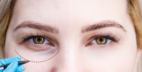 Plastic surgeon drawing dashed line under eye of girl. Hand in blue glove holding pencil. Plastic...