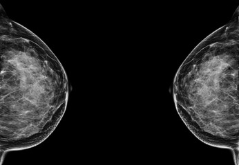  X-ray Digital Mammogram  or mammography  of the breast  CC view.