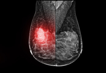  X-ray Digital Mammogram  or mammography  of the breast  mlo view.