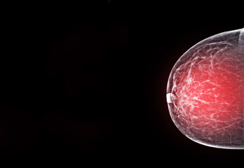  X-ray Digital Mammogram  or mammography  of the breast  CC view.