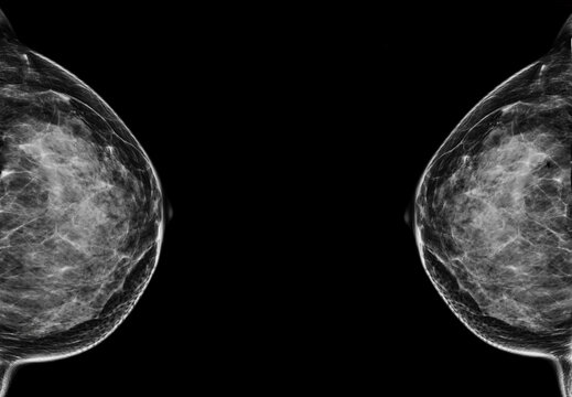  X-ray Digital Mammogram  or mammography  of the breast  CC view.
