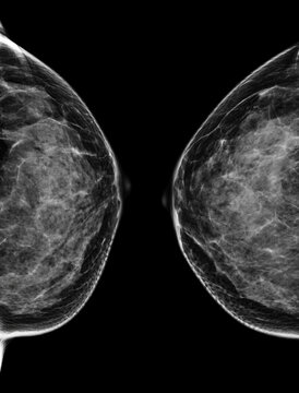  X-ray Digital Mammogram  or mammography  of the breast  CC view.