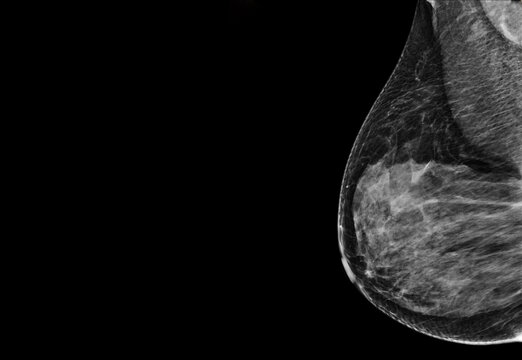  X-ray Digital Mammogram  or mammography  of the breast  mlo view.
