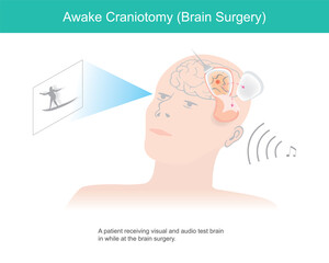 Awake craniotomy. A patient receiving visual and audio test brain in while at brain surgery.