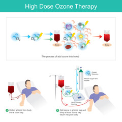 High Dose Ozone Therapy. This process add ozone in a blood bag and bring a blood from a bag return into your body.. - obrazy, fototapety, plakaty