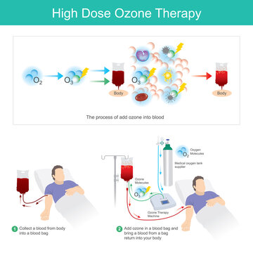 High Dose Ozone Therapy. This process add ozone in a blood bag and bring a blood from a bag return into your body..