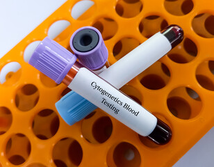 Blood sample for Cytogenetics blood testing to chromosomal analysis of blood for specific gene...