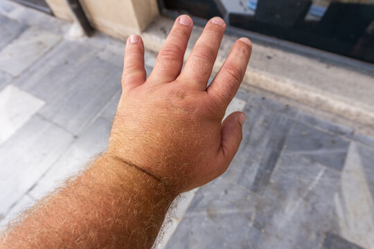 Close-up, male hand swollen from a wasp sting.