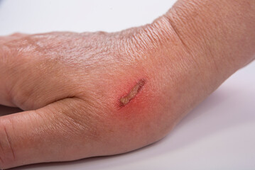 Burn on female hand from a cooking pot on a white