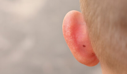 skin sunburnt of child ears from sun close up. back view. summer hot vacation. health and medical...