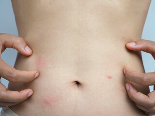 Woman scratching her stomach. caused by hives, insect bites, health care concepts. closeup photo,...
