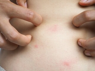 Young woman hand scratching an itch on red point sensitive skin as food or pest allergy symptoms on...