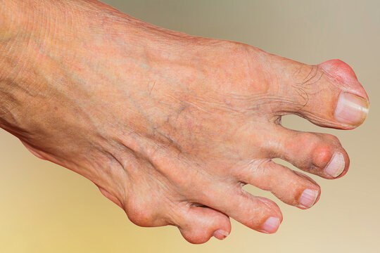 Severe gout in men suffering from joint pain, bone pain, gout, rheumatoid symptoms, radioactive sickness, ill man concept of male osteoporosis, injured bone, injury, pain, arthritis,arm, foot, knee