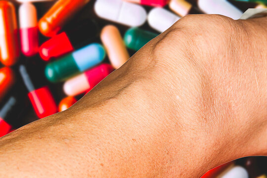 Severe gout in men suffering from joint pain, bone pain, gout, rheumatoid symptoms, radioactive sickness, ill man concept of male osteoporosis, injured bone, injury, pain, arthritis,arm, foot, knee