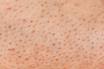 Closeup of caucasian skin with ingrown hair