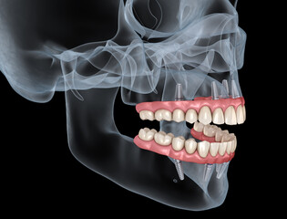 Maxillary and Mandibular prosthesis with gum All on 4 system supported by implants. Medically accurate 3D illustration of human teeth and dentures