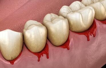Fototapeta na wymiar Bleeding gums or Periodontal - pathological inflammatory condition of the gum and bone support. Dental 3D illustration