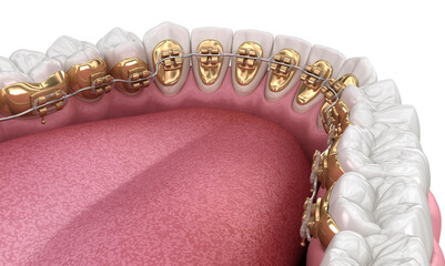 Healthy Teeth with gold braces, white style concept, dental 3D illustration