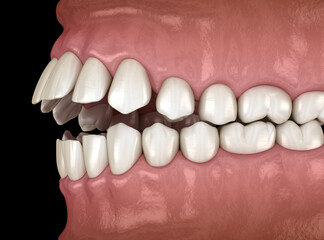 Openbite dental occlusion (Malocclusion of teeth). Medically accurate tooth 3D illustration - obrazy, fototapety, plakaty