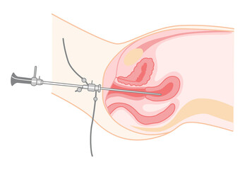Hysteroscopy of Female reproductive system treat examine Diagnostic uterus. Side view in a cut. Human anatomy internal organs location scheme flat style icon. Vector medical illustration isolated