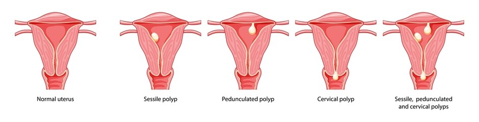 Set of Polyps in the uterus Female reproductive system in cross sections diseases and normal. Front view in a cut. Human anatomy internal organs location scheme, cervix, ovary flat style icon
